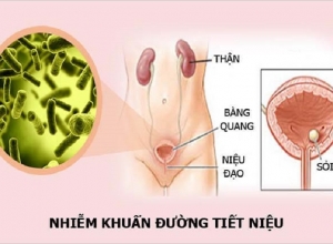 Tìm hiểu về nhiễm trùng đường tiết niệu